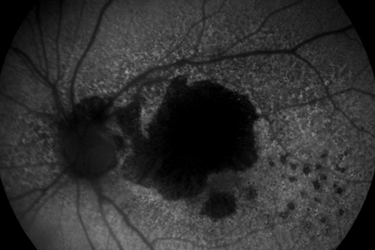 Degeneración Macular Relacionada a la edad